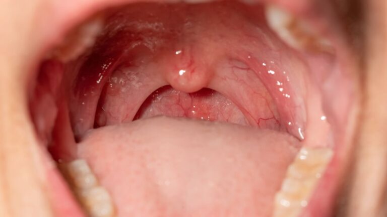 Uvula szerepe: miért fontos a szájpadlás kis függeléke?